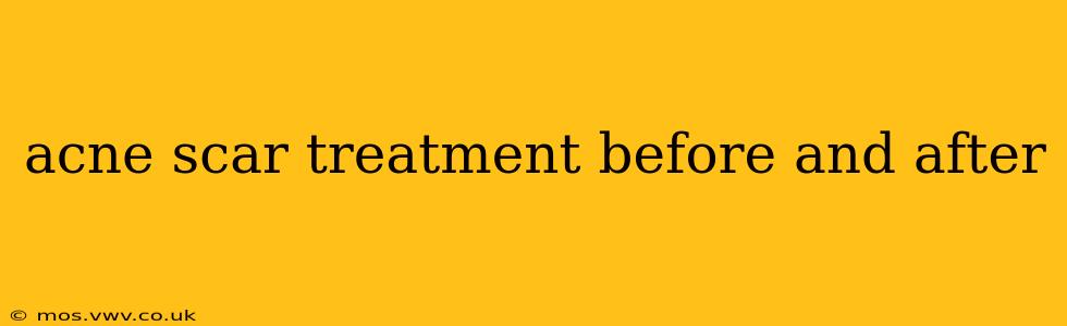 acne scar treatment before and after