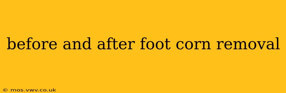 before and after foot corn removal