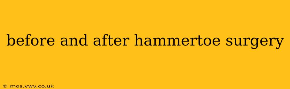 before and after hammertoe surgery