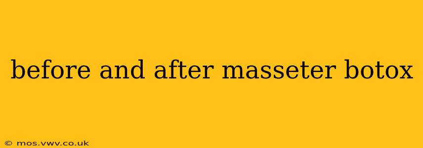 before and after masseter botox