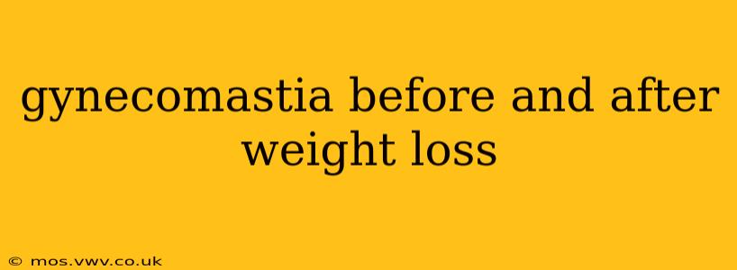 gynecomastia before and after weight loss