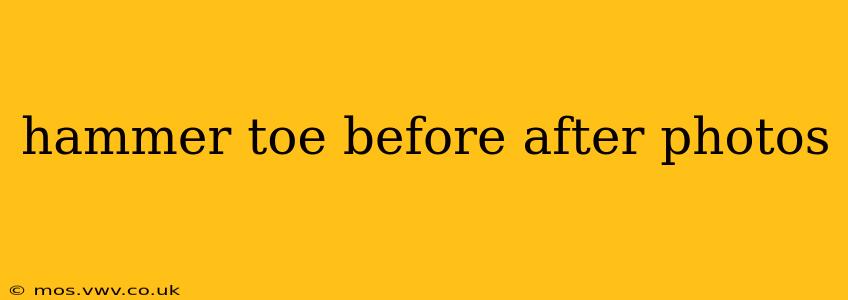 hammer toe before after photos