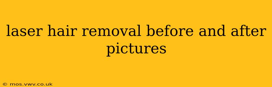 laser hair removal before and after pictures