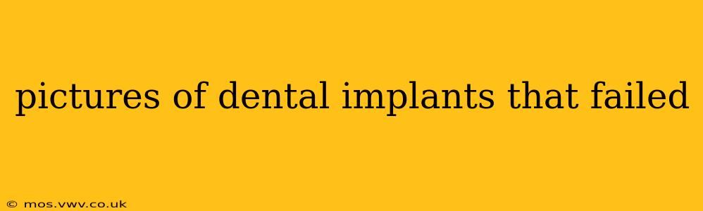 pictures of dental implants that failed