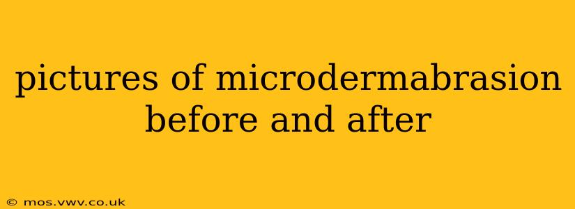 pictures of microdermabrasion before and after