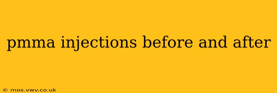 pmma injections before and after
