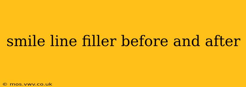 smile line filler before and after