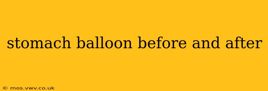 stomach balloon before and after