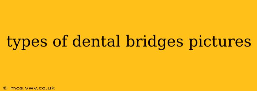 types of dental bridges pictures