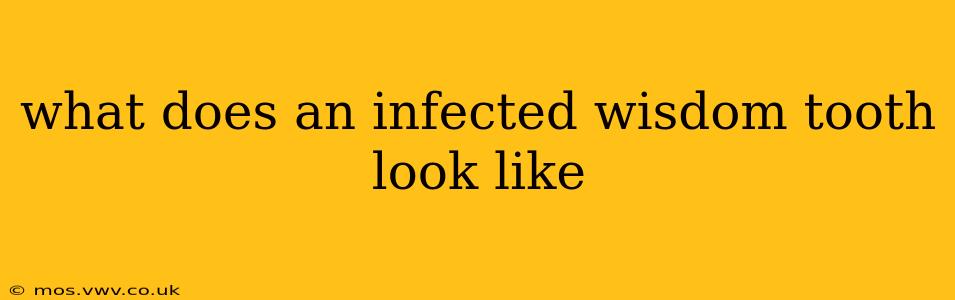 what does an infected wisdom tooth look like